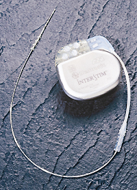 변실금 치료 천수신경조절술 상용화 임박