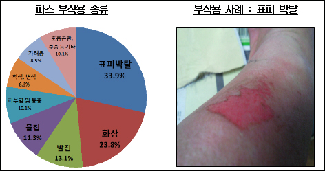 파스 부작용 주의보…"약국 복약지도 잘해주세요"