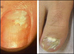 여름철 앞두고 손발톱 무좀치료제들 약국시장 공략