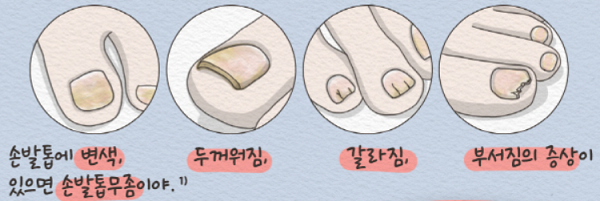 자꾸 재발하는 무좀 "반짝 아닌 지속 치료 중요"
